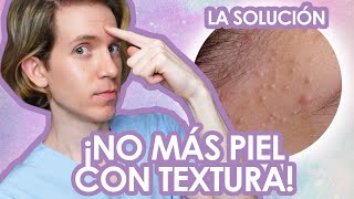 Como ELIMINAR los COMEDONES CERRADOS  Fácil y efectivo  Recomendaciones de un dermatologo [upl. by Acinnor]