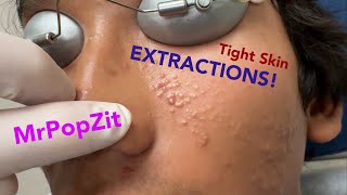 Tight skin acne extractions Comedonal acne with some inflammatory nodules Great session must see [upl. by Allicerp]