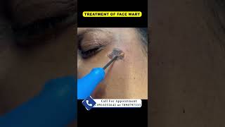 Treatment of face wart  By Dr Uttam Kumar Lenka MBBS MD Consultant Dermatologist [upl. by Dion]