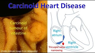 Carcinoid Heart Disease [upl. by Joed]