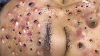 Loan Nguyen Acne Treatment 1464 [upl. by Yllib13]