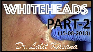 ANTI ACNE TREATMENT PART2 BY DRLALIT KASANA15082018 [upl. by Iggy]