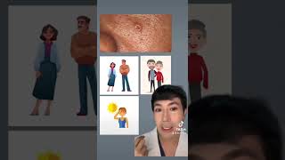 How to treat Sebaceous Gland Hyperplasia [upl. by Osnofla362]