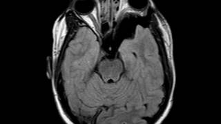 Sphenoid Wing Dysplasia [upl. by Katerina60]