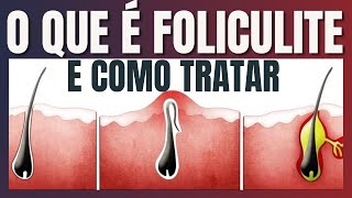 O que é Foliculite e como tratar [upl. by Ecirrehs]