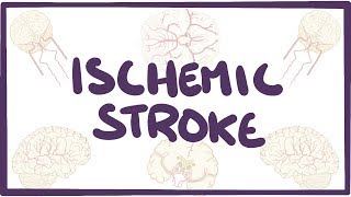 Ischemic Stroke  causes symptoms diagnosis treatment pathology [upl. by Lonni]