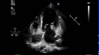 Mitral valve vegetation infective endocarditis [upl. by Zebaj]