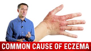 Is Your Eczema Coming from a Salicylate Sensitivity – Dr Berg On Atopic Dermatitis [upl. by Amadeus]