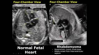 Fetal Chest Ultrasound Normal Vs Abnormal Image Appearances  Echocardiography  Heart amp Lungs USG [upl. by Eetsirhc208]