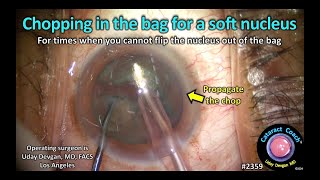 CataractCoach™ 2359 chopping in the bag for a soft nucleus [upl. by Hsekin]