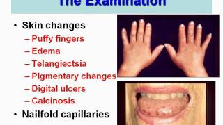 Webinar Scleroderma a Vascular Disease with Dr Fredrick Wigley 2012 [upl. by Ellicott216]