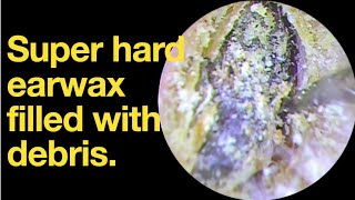 Super hard earwax filled with debris ear wax removal  ear cleaning  ASMR  relaxation  relax [upl. by Annavaig]