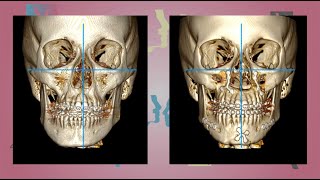 Case 14  Orthognathic surgery  Facial Asymmetry  English [upl. by Anawot]