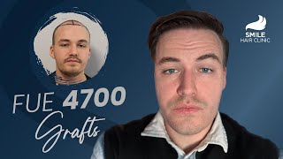 4700 Grafts Hair Transplant  12Month Amazing Results  Before amp After Transformation [upl. by Mencher57]