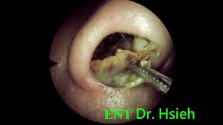 ENT local treatment after RT 3 weeks 010 鼻中膈鼻道成形手術術後三週耳鼻喉局部治療 [upl. by Pappano]