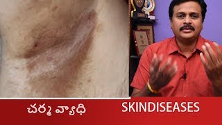 HOW TO SOLVE ERYTHRASMA SKIN DISEASES IN TELUGU CORYNEBACTERIUMHOMEOPATHIC TREATMENT WAKEUP [upl. by Aeslehc]