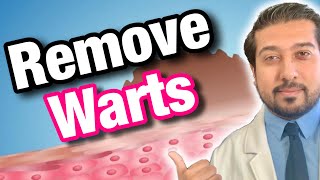 Wart Removal 101  How to Get Rid of Warts [upl. by Tioneb66]