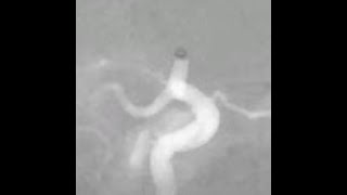 LIVE cereglide direct aspiration acute left ICA occlusion [upl. by Yramliw]