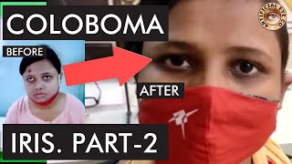 Iris coloboma  What is Coloboma  Treatment  Dr Sumitra  Hindi  Part 2 [upl. by Adnahcir]