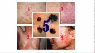 Common Skin Diseases and Disorders [upl. by Finah264]