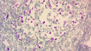 Cryptococcus neoformans under the microscope with McManus’ PAS stain [upl. by Madelle]