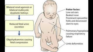 Oligohydramnios and polyhydroaminos 2 [upl. by Enimassej]