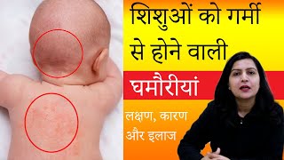 शिशुओं को घमौरी होने के कारण लक्षण व घरेलू उपचार  Heat rash or prickly heat in Hindi My Baby Care [upl. by Richlad]