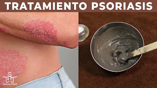 PSORIASIS en la PIEL ⚡  El MEJOR TRATAMIENTO en 3 PASOS 💧 [upl. by Eittap]