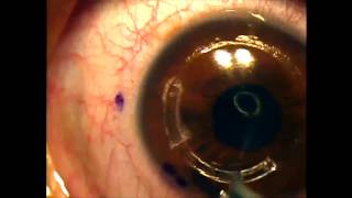 Intacs for keratoconus using the intralase femtosecond laser [upl. by Cosetta945]