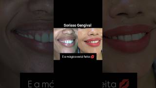 Sorriso gengival beauty skincare botox lábios estetica belezaquetransforma [upl. by Tish]