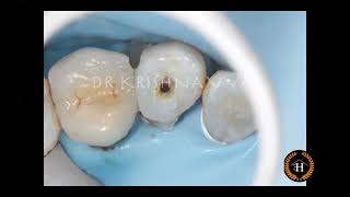 Canal projection for badly mutilated teeth reinforcement amp pre endo build up [upl. by Terr437]