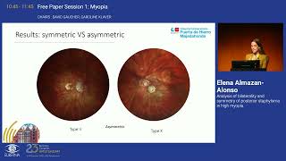 7 Analysis of bilaterality and symmetry of posterior staphyloma in high myopia [upl. by Iohk]