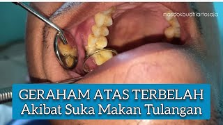 Bagaimana Penanganan Geraham Atas Mahkotanya Terbelah Akibat Suka Makan Keras Tulangan [upl. by Yelyk]