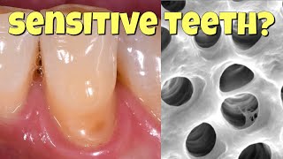 Why teeth get sensitive and how to fix it [upl. by Htrow]