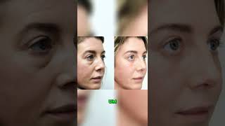 Blepharoplasty Recovery  Day 5 after surgery [upl. by Hart]