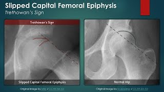 Slipped Capital Femoral Epiphysis Plain Radiography [upl. by Harle773]