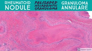 Rheumatoid Nodule amp Granuloma Annulare Palisaded Necrobiotic Granuloma Pattern Dermatopathology [upl. by Lleneg556]