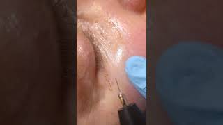 FIBROBLAST  SKIN TIGHTENING lower eyelids [upl. by Esereht]