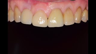 Immediate Implant Placement amp Minimally Invasive Horizontal Ridge Augmentation  Part 2 [upl. by Jenn]