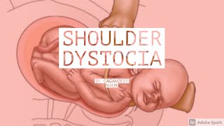 SHOULDER DYSTOCIAUnit8 OBG Abnormal Labour [upl. by Devlin]