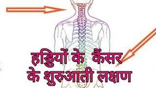 हड्डियों के कैंसर के लक्षणhaddi ke cancer ke lakshanbone cancer symptoms hindi [upl. by Cira]