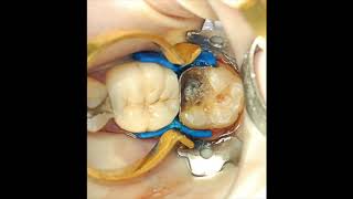 Restoring that broken molar and the difficult class II cavity [upl. by Birgit]