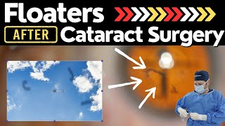 Cataracts amp Floaters [upl. by Onailimixam]