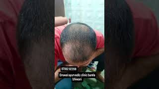 Hair treatment in our patient haircare hairgrowth hairfall hairtreatment alopedand ganjapan [upl. by Mortie]