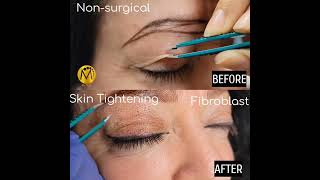 Fibroblast Skin Tightening Mussa Beauty Studio  Phoenix Az [upl. by Hu]