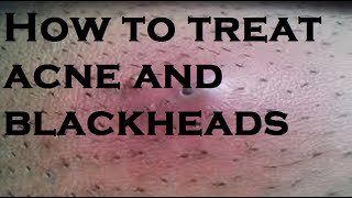 How to treat acne and blackheads [upl. by Georgiana]