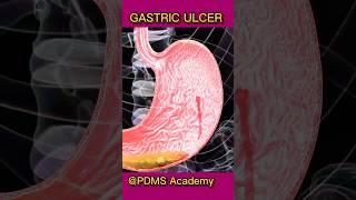 Gastric Ulcer  causes and treatment medicine healthcare [upl. by Nanerb950]