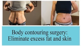 Body Contouring Surgery To Eliminate Excess Skin amp Fat  The Esthetic Clinics India [upl. by Marino]