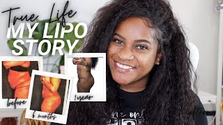 MY PLASTIC SURGERY STORY ABDOMINAL LIPOSUCTION  1 YEAR POST OP LIPO MOREPHEUS8 AND BODYTITE [upl. by Eenoj201]