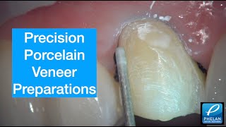 Precision Porcelain Veneer Preparation with a Zeiss ProErgo microscope [upl. by Ailecec82]